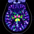 innovative-imaging-tracer-uncovers-tumors’-fat-fueled-growth-mechanism
