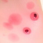 unraveling-genes-behind-dermatophytosis-skin-vulnerability