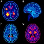 brain-metastases-in-renal-cancer:-immune-insights