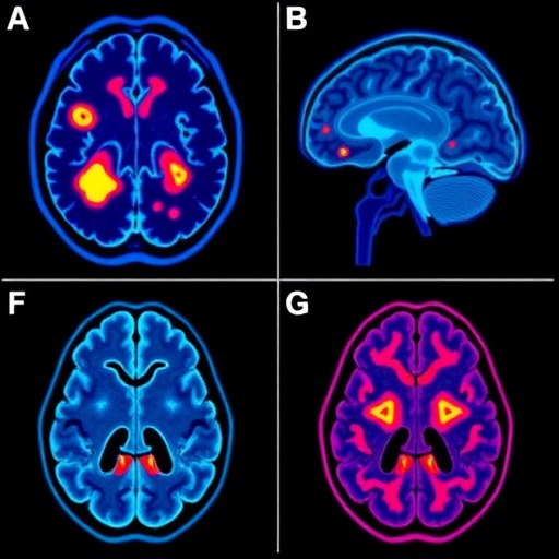 brain-metastases-in-renal-cancer:-immune-insights