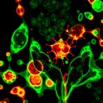 myc-amplification-in-metastatic-prostate-cancer-linked-to-decreased-tumor-immunogenicity