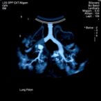 lung-ultrasound-tracks-preterm-infants’-bpd-risk