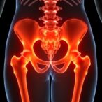 successful-infix-results-for-pelvic-fragility-fractures