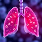 inhibiting-lipid-production-in-healthy-lung-cells-may-decrease-lung-metastasis