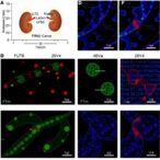 fut8-drives-kidney-cancer-via-pkm2-lactylation