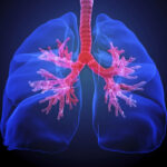 metastasis-slowed-by-targeting-lipid-metabolism-in-healthy-lung-cells