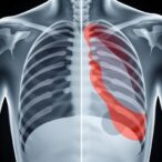 total-thoracoscopic-vs.-small-incision-surgery:-rib-fracture-study