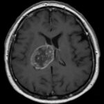 glioblastoma-growth-mechanism-identified,-pointing-to-potential-therapeutic-targets