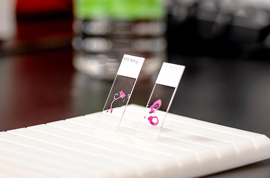 bringing-tumor-complexity-into-focus