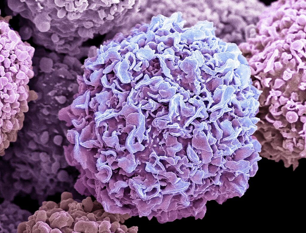 immune-response-gene-variants-tied-to-earlier-breast-cancer-in-brca1-carriers