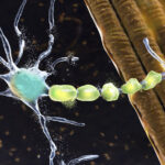 biological-complexity-of-als-to-be-addressed-by-the-development-of-new-stem-cell-models