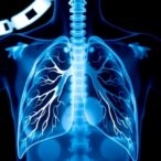 mount-sinai-study-reveals-lung-cancer-surgery-is-safe-for-numerous-patients-aged-over-80