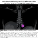 targetable-markers-define-antiprogestin-resistant-breast-cancer