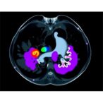 foundation-ai-model-advances-breast-ultrasound-analysis