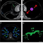 furmonertinib-plus-bevacizumab-boosts-egfr-tki-resistance-outcomes
