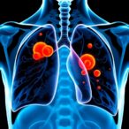 tumor-location-influences-chemoradiotherapy-success-in-lung-cancer