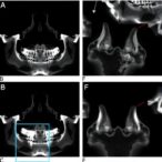 snps-in-filip1-senp6,-fto-linked-to-tmj-osteoarthritis
