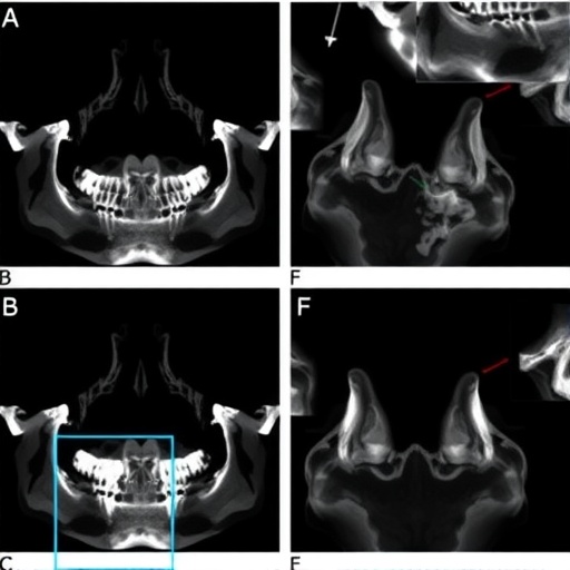 snps-in-filip1-senp6,-fto-linked-to-tmj-osteoarthritis
