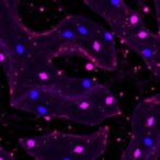 plasma-p-tau217-detects-amyloid-β-in-synuclein-disease