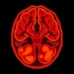 cabozantinib-and-temozolomide-treat-advanced-neuroendocrine-tumors