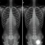 preop-t1-slope-minus-lordosis-predicts-surgery-outcomes