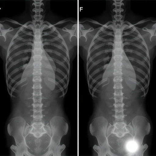 preop-t1-slope-minus-lordosis-predicts-surgery-outcomes