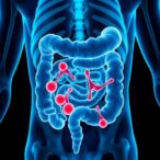 new-biomarker-identified-to-predict-immunotherapy-success-in-colon-and-rectal-cancer-patients