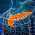 landmark-pancreatic-cancer-trial-highlights-promise-of-ras-targeting-daraxonrasib
