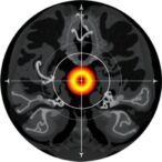 assessing-target-irregularity-as-a-key-factor-in-gamma-knife-treatment-planning