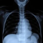 predicting-tracheostomy-or-death-in-severe-bpd