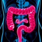 rectal-cancer-emerging-sooner-and-progressing-more-aggressively,-study-finds