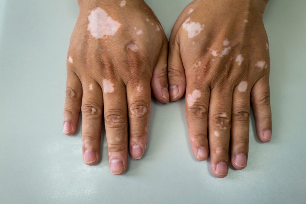 incyte’s-jak-inhibitor-scores-phase-3-vitiligo-wins-but-can’t-quite-shake-off-rinvoq