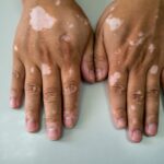 incyte’s-jak-inhibitor-scores-phase-3-vitiligo-wins-but-can’t-quite-shake-off-rinvoq