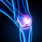 first-human-trial-of-osca-therapy-for-knee-oa
