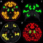 tdp43-mislocalization-drives-disc-degeneration-and-aging