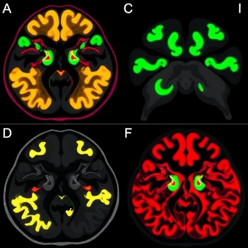 tdp43-mislocalization-drives-disc-degeneration-and-aging