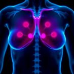 innovative-therapy-lowers-breast-density-with-minimal-side-effects