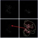oligometastatic-prostate-cancer:-linking-local-and-metastatic