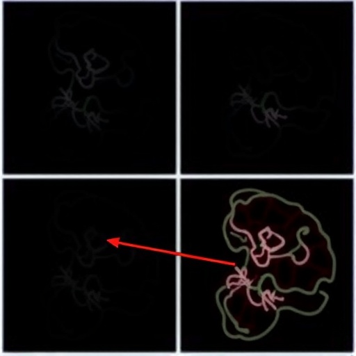 oligometastatic-prostate-cancer:-linking-local-and-metastatic
