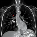 lung-ultrasound-detects-necrosis-in-pediatric-pneumonia