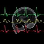 continuous-eeg-reveals-seizures-after-neonatal-heart-surgery