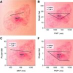 epidermal-mhc-ii-drives-nk-cell-attack-in-psoriasis