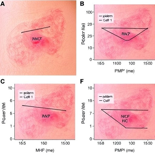 epidermal-mhc-ii-drives-nk-cell-attack-in-psoriasis