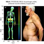 nela,-p-possum,-muscle-index-predict-elderly-surgery-risk