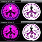 carboplatin-±-nivolumab-in-metastatic-tnbc-trial