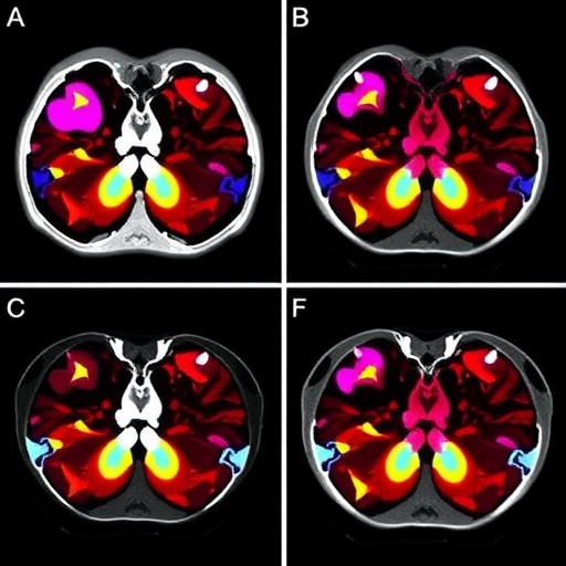 targeted-radiotherapy-extends-control-of-early-stage-breast-cancer-spread