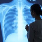 landmark-eortc-study-reevaluates-role-of-lymph-node-radiation-in-breast-cancer-treatment