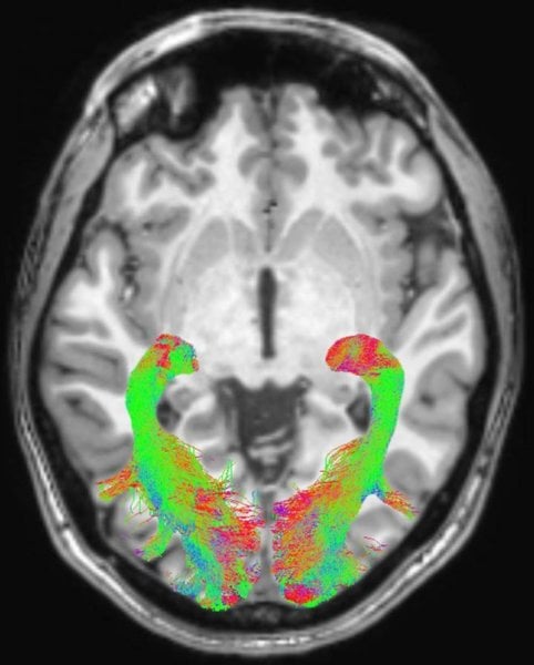 herantis-taps-indivi-for-digital-biomarker-tech-in-parkinson’s-disease-trial