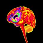cerebral-nirs:-key-in-managing-post-hemorrhagic-dilation?