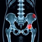 assessing-osteoporotic-pelvis-fracture-score-feasibility